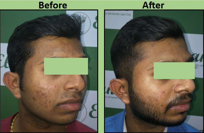Acne Chemical Peel Treatment in Surat