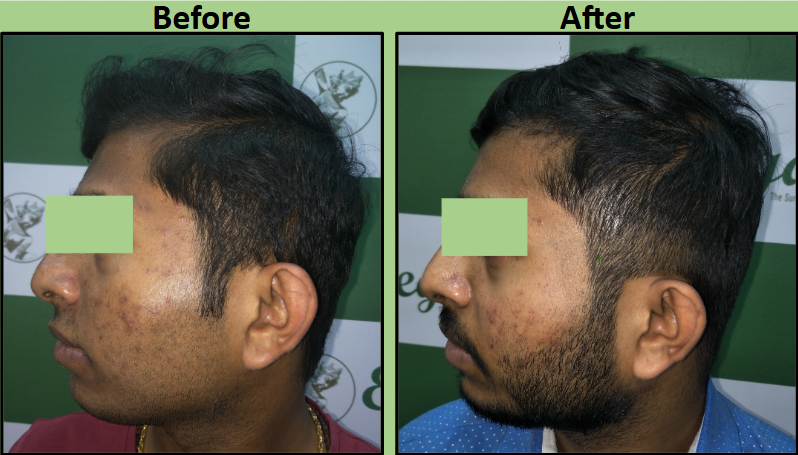 Best Acne Chemical Peel Treatment in Surat