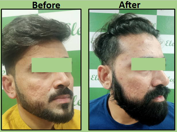 Top Acne Scar Subcision And Dermal Filler