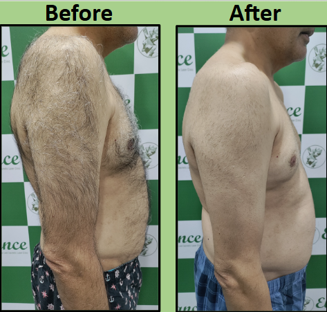 Best Laser Hair Removal for male in Surat