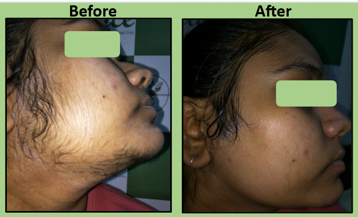 Best Laser Hair Removal for pcos in Surat