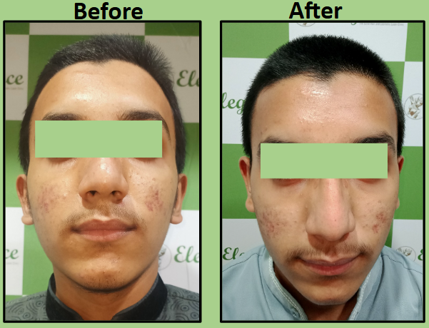 no 1 Acne Medical Management in Surat