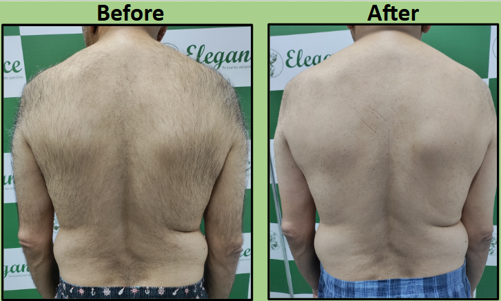 No 1 Laser Hair Removal for male in Surat