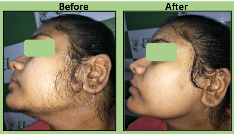 permenent Laser Hair Removal for pcos in Surat