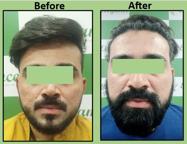 Best Acne Scar Subcision And Dermal Filler